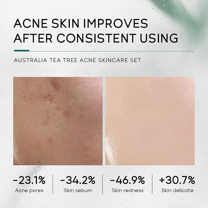 Skin Care Set,Acne Treatment for Face Skin Care Sets & Kits,Tea Tree Essential Oil Facial Skincare Gift Set with Cleanser,Toner,Serum,Gel, Acne Treatment Kit Cream Skin Care for Teens 10-12 Girls Boys