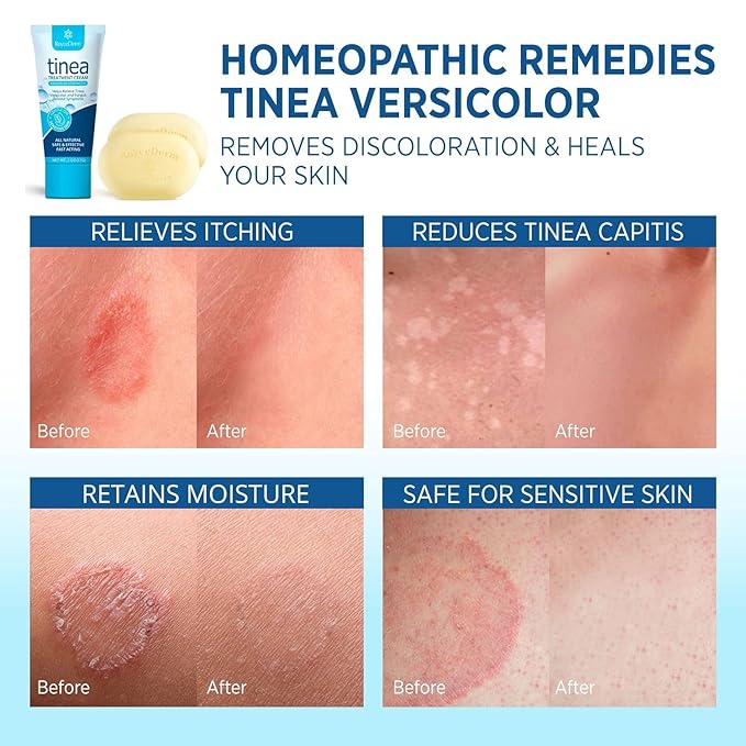 Tinea Versicolor Relief Cream & Soap: Clinically Proven Treatment for Tinea Versicolor, Athlete’s Foot, Ringworm, and Fungal Skin Conditions – Soothes, Cleanses, and Restores Skin Health