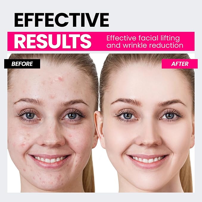 Microcurrent Facial Device,Latest Red Light Technology,Enhances The Ability to Lift The Face and Tighten The Skin,Facial Wrinkle Equipment,Smart Photon Micro-Current Device,Model:EP-300.