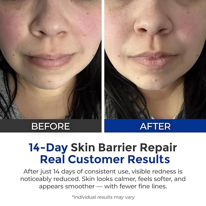 Intensive Repair Serum, 15% Hyaluronic Acid Serum with Ceramides and Centella Extract, Barrier Repair Redness Reilef Rosacea Treatment for Face Sensitive Acne Prone Skin, 30 Vials