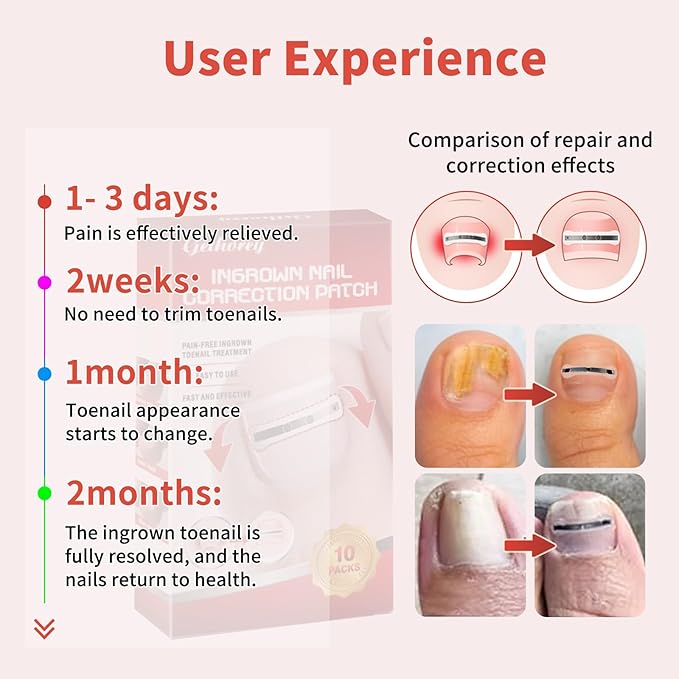 Ingrown Toenail Treatment, 10 packs Titanium Alloy Ingrown Toenail Corrector for all size foot, Ingrown Toenail Removal Kit for Curved Nail Repair, at Home Nail Kit Tools-Q03