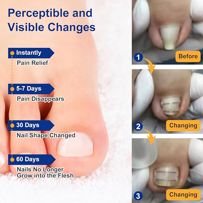 Nitinol Ingrown Toenail Corrector,at Home Ingrown Toenail Treatment,Curved Toenail Straightener,Ingrown Toe Nail Relief，Ingrown Toenail Removal Kit (11/16 In,13/16 In)