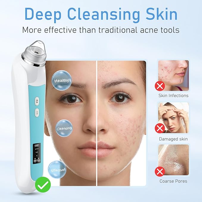 Blackhead Removal Vacuum with HD Camera, 6 Suction Heads & 3 Adjustable Settings, USB Rechargeable Pore Cleaner for Men and Women(Sky Blue)