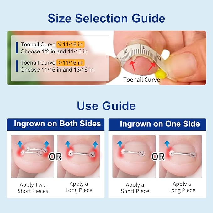 Nitinol Ingrown Toenail Corrector,at Home Ingrown Toenail Treatment,Curved Toenail Straightener,Ingrown Toe Nail Relief，Ingrown Toenail Removal Kit (1/2 In,11/16 In)