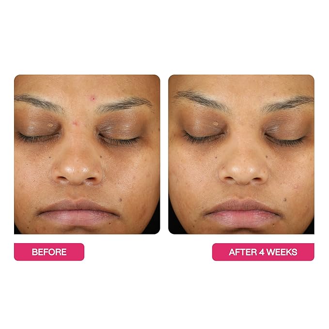 BeautyStat Triple Action One-Step Daily Exfoliating Peel Pad for Uneven Tone, Texture, Fine Lines, Enlarged Pores - Made in the USA - Gentle Exfoliator Pad with AHAs, BHAs, Glucosamine to Brighten