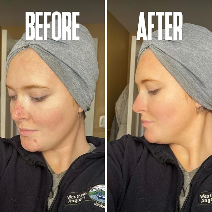 Anti Aging Skin Care Set: Glycolic Acid Peel 70% & Glycolic Resurfacing Pads - This Ultra Potent Duo Will Purify Your Skin & Eliminate Wrinkles, Acne Scarring For an Ultra Clear & Glowing Complexion