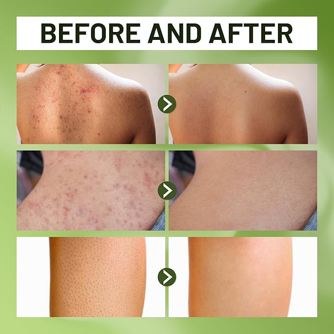 ABERA Folliculitis, BHA Shower Gel, High-Performance Folliculitis Body Wash, Wild Bitter Melon Extract, Reduces Back Acne & Hyperkeratosis,10,14 fl oz (3 Boxes + BHA Back Acne Spray)