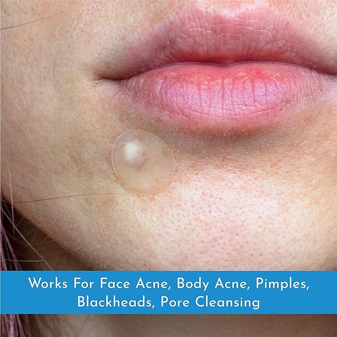 Hydrocolloid Acne Patches for Face & Body - 72 Count | Pimple Stickers for Breakouts, Zits, Blemishes & Imperfections | Cruelty-Free Cover Dots for Overnight Results