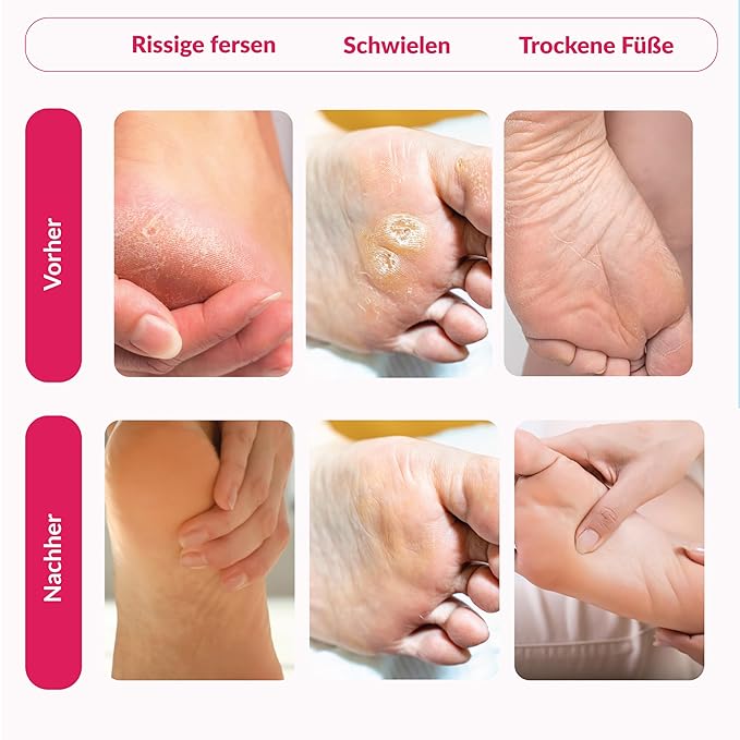 Peeling Mask That Removes Dead Skin - Dermatologically Tested Callus Remover for Dry Cracked Feet - Exfoliating Foot Peel Mask for Baby Soft Feet - Cucumber & Urea Extracts