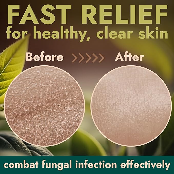 Antifungal & Antibacterial Body Wash with Tea Tree Oil | Homeopathic Medicine for Jock Itch, Athlete’s Foot, Ringworm, Back Acne & Eczema | Antibacterial Soap for Men & Women | 1 Gallon Pump Dispenser