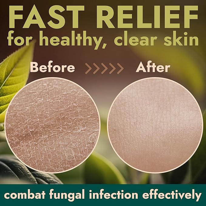 Antifungal Body Wash with Tea Tree Oil | Antibacterial Soap for Back Acne,Treats Ringworm, Eczema & Jock Itch | Antibacterial Body Soap For Men And Women | Includes Silicon Body Scrubber (16.9 oz)