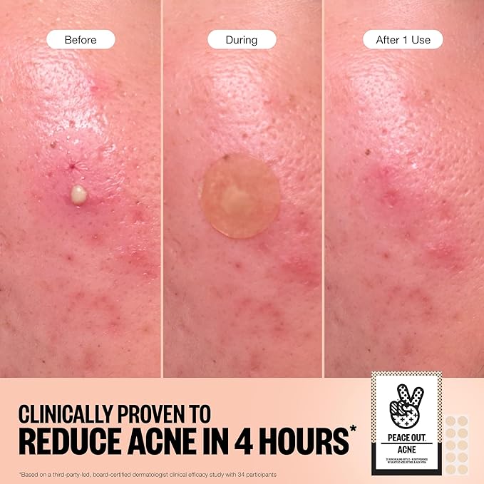 PEACE OUT Acne Healing Dots Helps Clear Blemishes Overnight, Fast Acting Hydrocolloid Pimple Patches for Breakouts with Salicylic Acid, Retinol and Aloe Vera, Award Winning Skincare Solution 60 Count