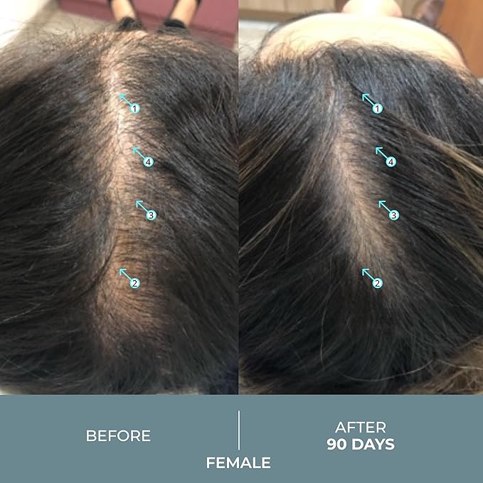 Revita.SOD Hair Growth Supplement by DS Laboratories - Experience Fuller, Thicker, Stronger Hair, Combat Hair Loss and Hair Thinning Caused by Stress, Reduce Hair Thinning, Balding, and Hair Shedding (30 Day Supply)