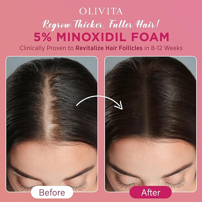 5% Minoxidil Foam for Women Hair Growth: Extra Strength Hair Regrowth Treatment – Revitalize Hair Follicles & Regrow Thicker, Fuller Hair – Hair Loss Solution