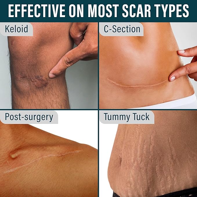 NUVADERMIS Silicone Scar Tape for Surgical Scars - 120" x 1.5" Roll - Extra Long Medical Grade Silicone Scar Tape for C-Section, Tummy Tuck, Keloid, and Surgical Scars - Reusable Tape Strips - 1 Pack