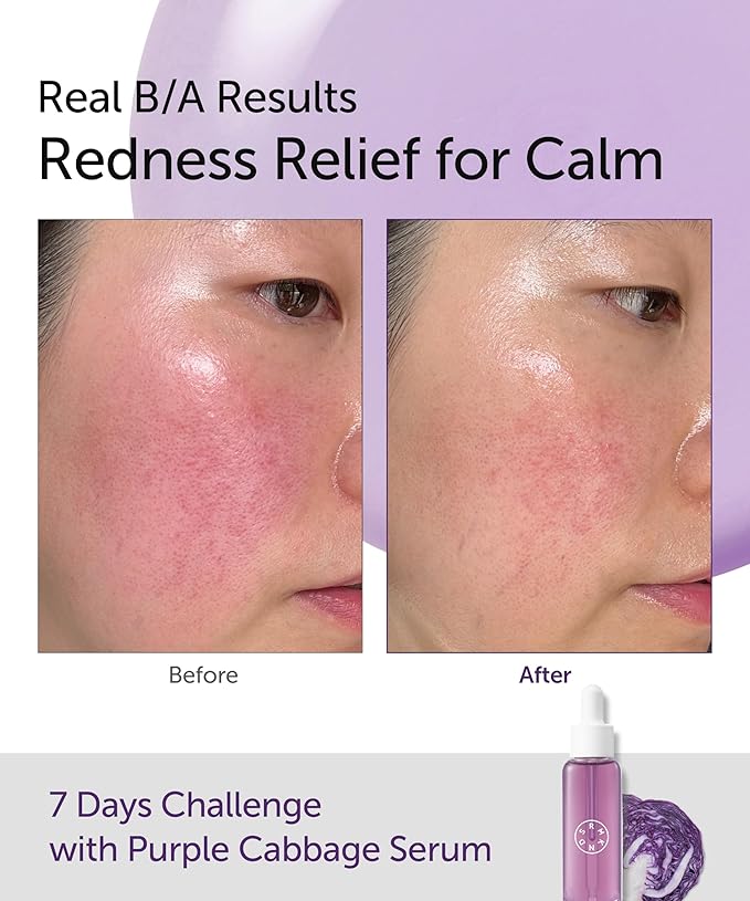 SERUMKIND Purple Cabbage Serum - Calming and Skin Recovery- Korean Face Skincare – Beta Glucan 100,000ppm – Soothing & Redness Relief - Vegan, Cruelty-Free – 1.01 fl.oz.
