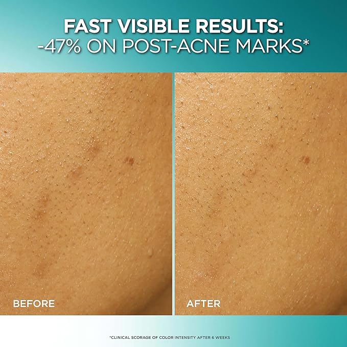 L'Oreal Paris Bright Reveal Dark Spot Exfoliant Peel, 25% AHA BHA PHA Face Exfoliator Solution, Gentle Skincare to Visibly Reduce Dark Spots and Renew Skin Texture, Includes SPF Lotion Sample