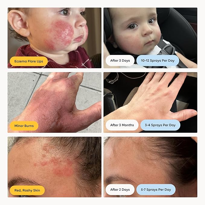 Skin Cleanser for All Types, Hypochlorous Acid Spray Helps Heal Acne Prone, Eczema and Itchy Rashes and 50 Other Skin Ailments, Safe for Multiple Daily Uses, 8 oz Spray