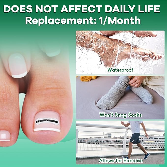 Titanium Alloy Ingrown Toenail Treatment New Version Ingrown Toenail Removal Tool Kit, Designed for Curved Nail Repair Big Toe Ingrown Toenail Corrector