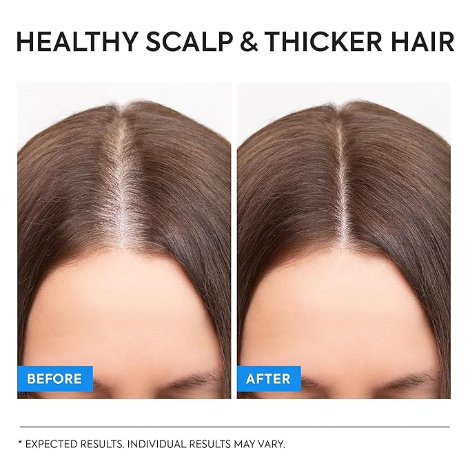 Fungal Scalp & Hair Loss Solution: Natural Therapeutic Shampoo & Conditioner Set for Psoriasis Folliculitis Itchy Bump Dandruff & Thinning Hair - Hair Growth with Rice Protein - Soothing, Sulfate-Free