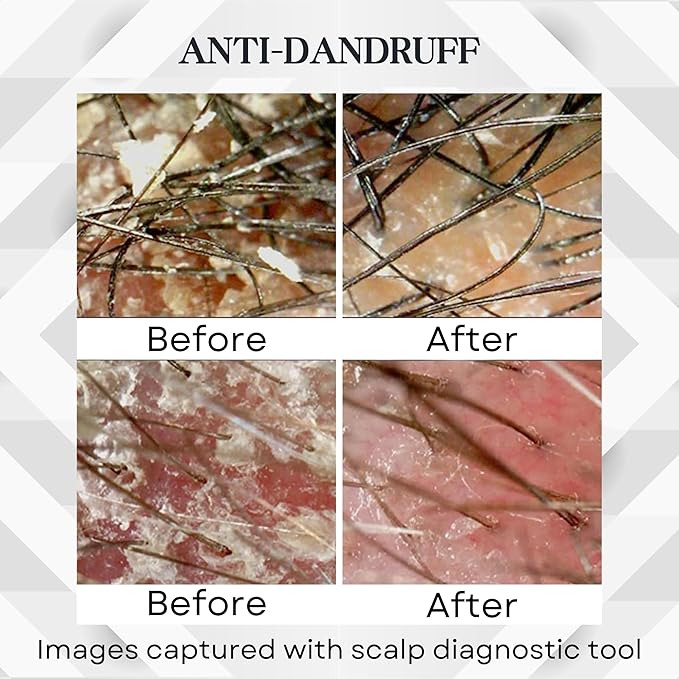 Abera Anti-Dandruff Shampoo for Stronger Hair & Healthier Scalp, Nourishes, Supports and Promotes Hair Growth, Get Rid of Dandruff, 6.67 fl oz, Set of 3