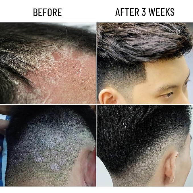 Abera Anti-Dandruff Shampoo for Stronger Hair & Healthier Scalp, Nourishes, Supports and Promotes Hair Growth, Get Rid of Dandruff, 6.67 fl oz, Set of 3