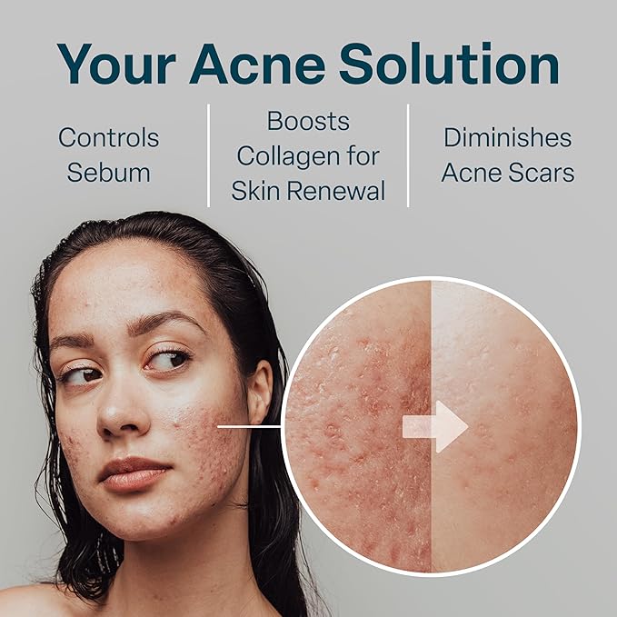 QRxLabs Glycolic + Salicylic Acid Acne Control Pads with 10% Ultra Pure Glycolic & 2% Salicylic, Allantoin, Vitamin B5, C & E, Calendula & Green Tea - Acne Treatment for Clear Skin