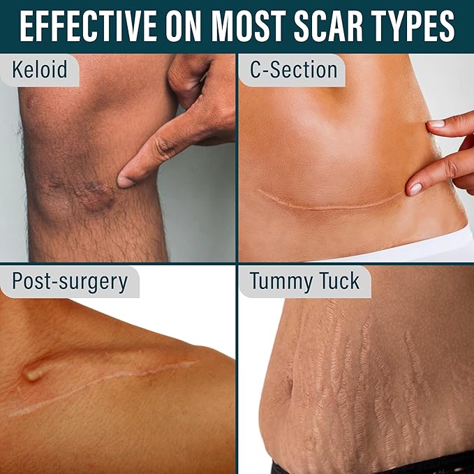 NUVADERMIS Clear Silicone Scar Tape for Surgical Scars - 120" x 1.5" Roll - Extra Long Scar Sheets for C-Section, Tummy Tuck, Keloid, and Surgical Scars - Reusable Medical Grade Silicone Scar Tape