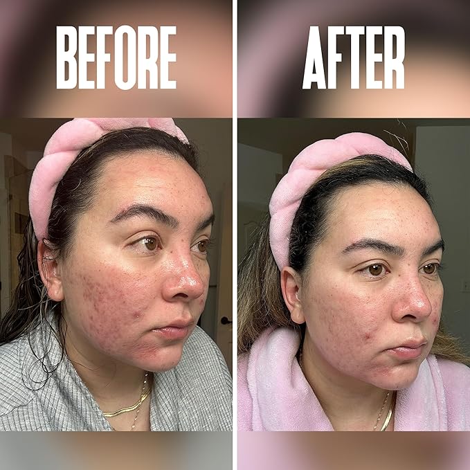 Anti Aging Skin Care Set: Glycolic Acid Peel 70% & Glycolic Resurfacing Pads - This Ultra Potent Duo Will Purify Your Skin & Eliminate Wrinkles, Acne Scarring For an Ultra Clear & Glowing Complexion