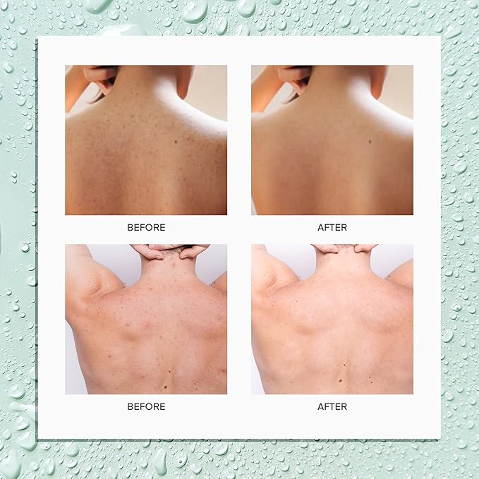 CIZ 2% Salicylic Acid Body Treatment with Herbal Formula, Tea Tree Oil For Teens, Back Acne Solution, 4.05 Ounce