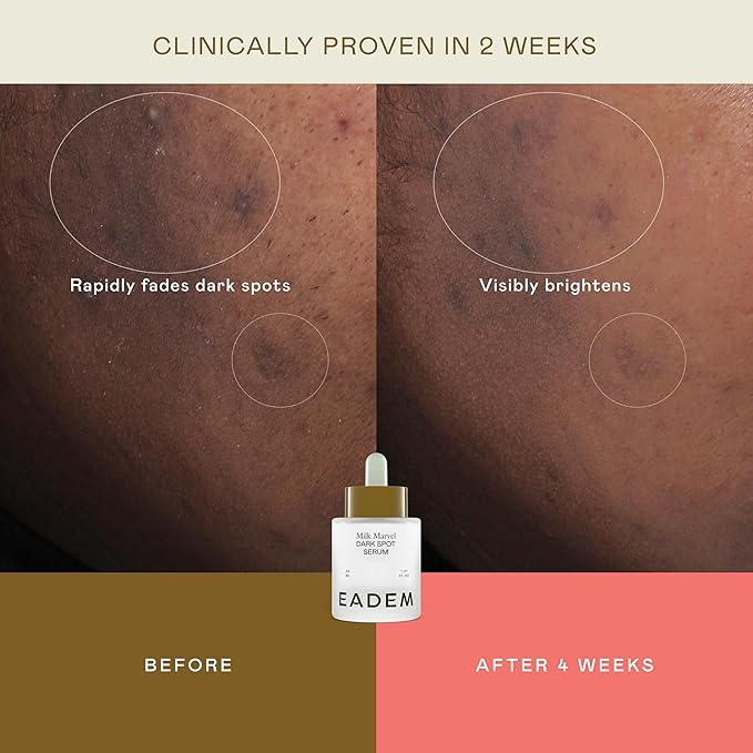 EADEM Milk Marvel Dark Spot Serum, Vitamin C Face Serum Infused with Niacinamide, Dark Spot Remover for Face & Body, Dark Spot Corrector for Skin Care, Mothers Day Gifts, 1 oz