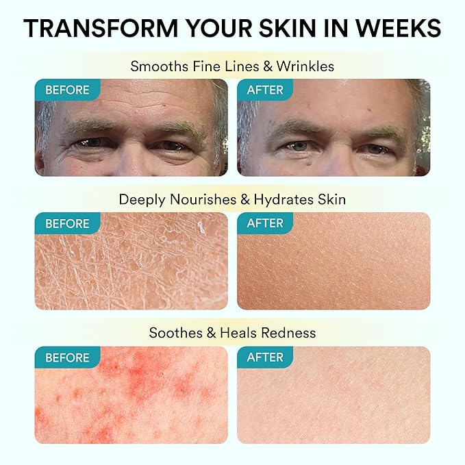 Tallow and Honey Balm for Face - Grass Fed Beef Tallow Moisturizer with Raw Manuka Honey, Olive Oil, Beeswax & Vitamin E - Nourishing Balm for Skin Hydration