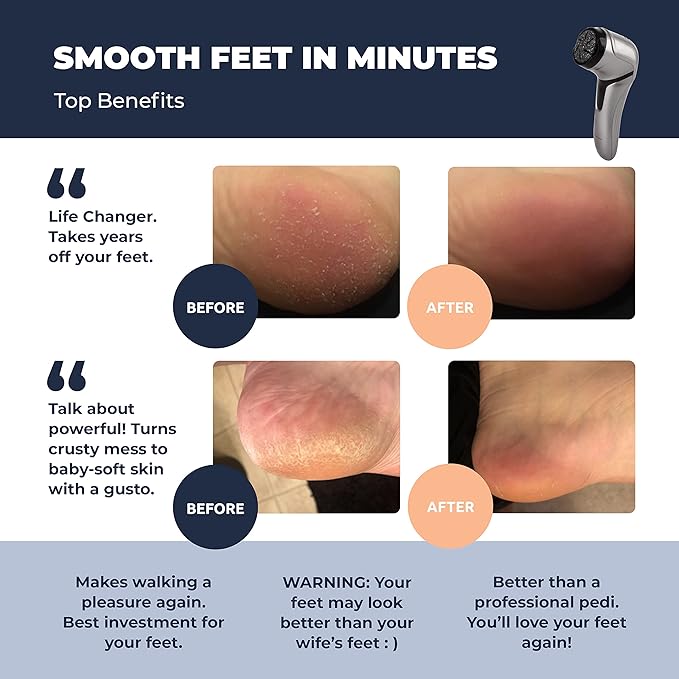 Electric Foot Callus Remover with Vacuum - Own Harmony Professional Pedicure Tools Kit for Powerful Pedi Feet Care Vac, Electronic Foot File CR2100, Best for Hard, Dry, Cracked, Dead Skin (3 Rollers)