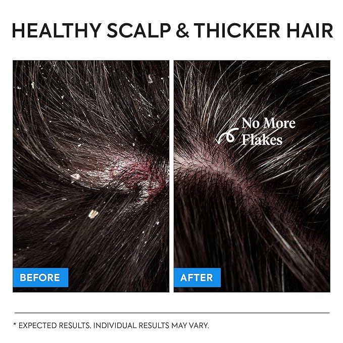 Fungal Scalp & Hair Loss Solution: Natural Therapeutic Shampoo & Conditioner Set for Psoriasis Folliculitis Itchy Bump Dandruff & Thinning Hair - Hair Growth with Rice Protein - Soothing, Sulfate-Free